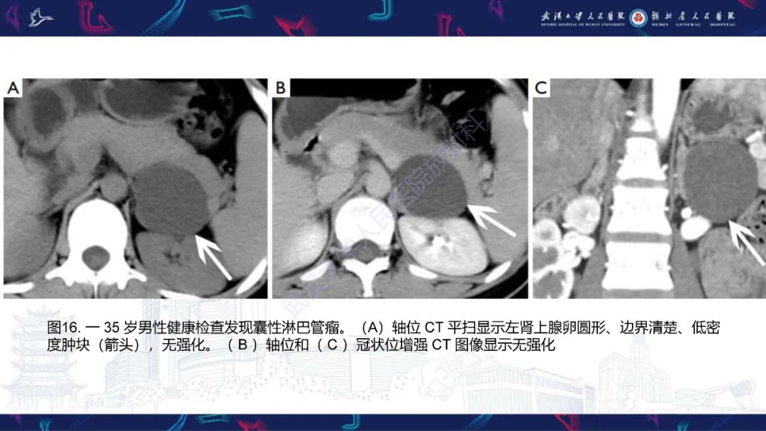影像PPT - 【PPT】肾上腺常见病变CT及MRI诊断-28