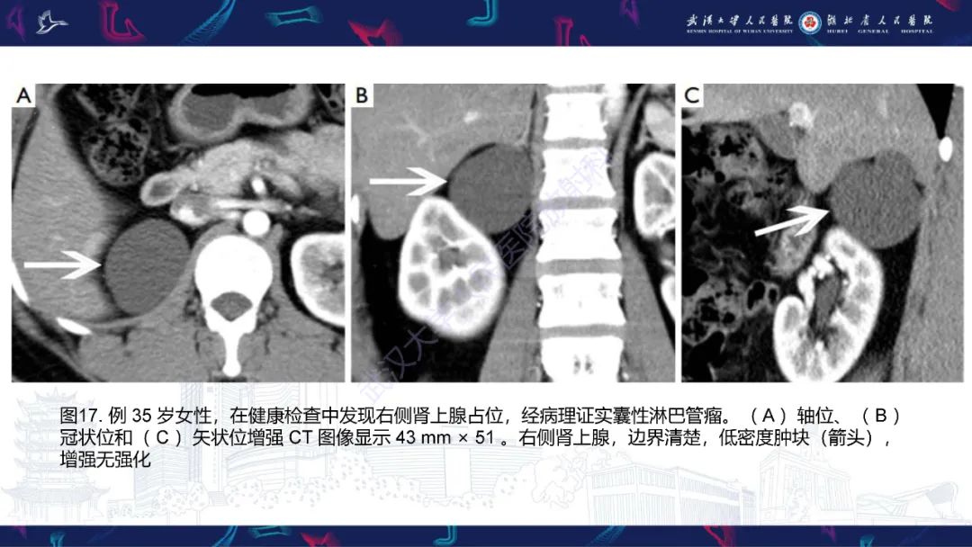 影像PPT - 【PPT】肾上腺常见病变CT及MRI诊断-29