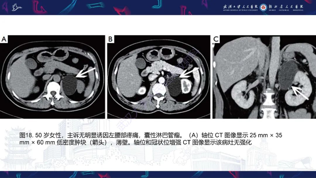 影像PPT - 【PPT】肾上腺常见病变CT及MRI诊断-30