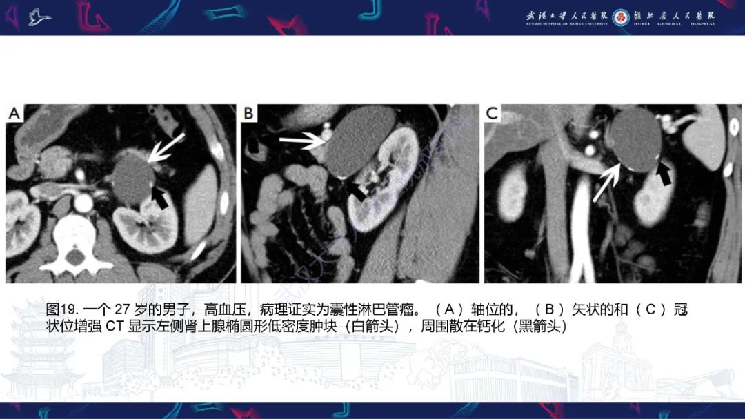 影像PPT - 【PPT】肾上腺常见病变CT及MRI诊断-31