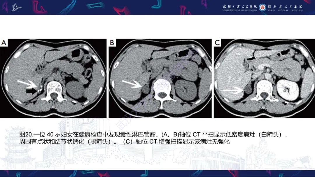 影像PPT - 【PPT】肾上腺常见病变CT及MRI诊断-32