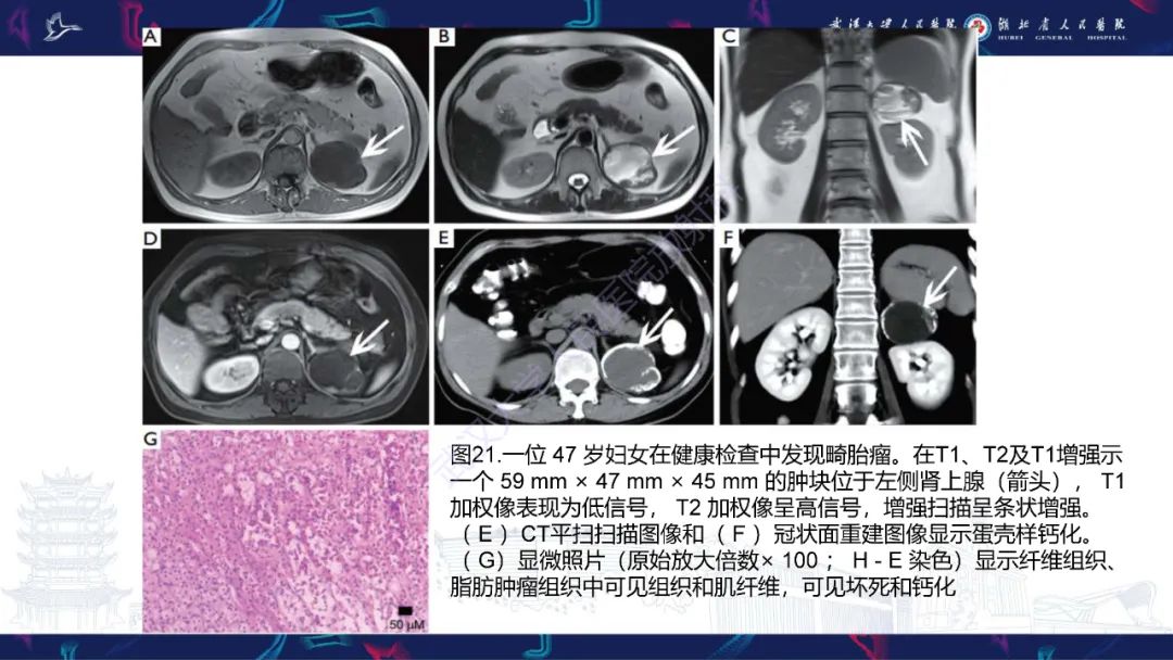 影像PPT - 【PPT】肾上腺常见病变CT及MRI诊断-34