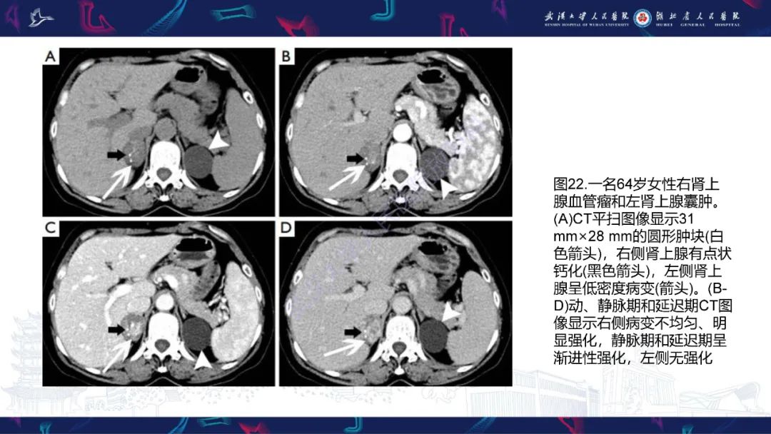 影像PPT - 【PPT】肾上腺常见病变CT及MRI诊断-38