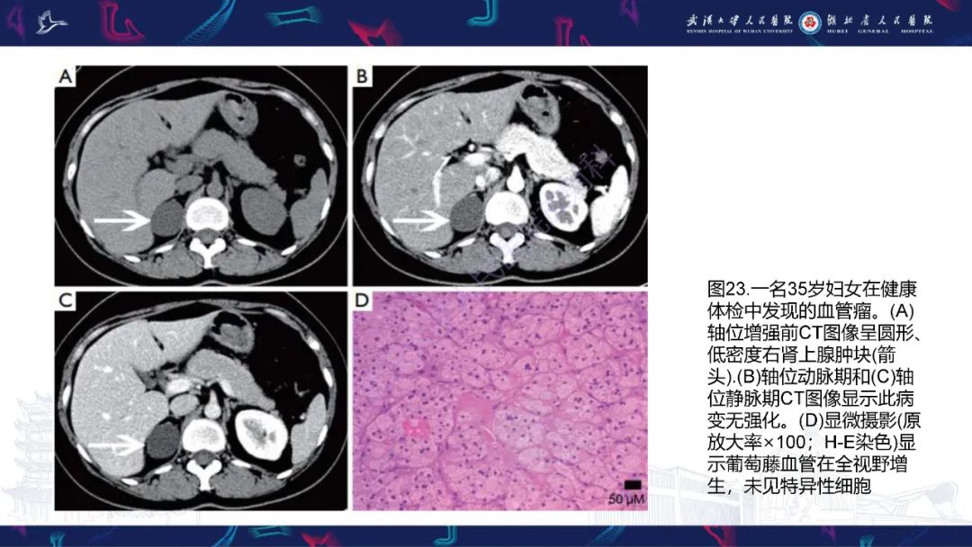 影像PPT - 【PPT】肾上腺常见病变CT及MRI诊断-39