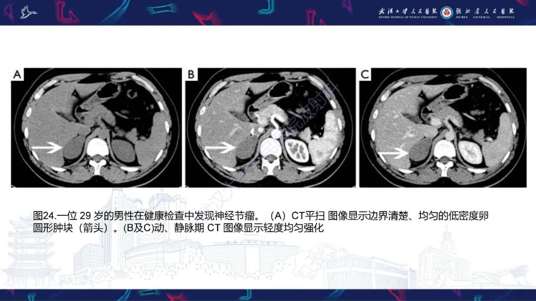 影像PPT - 【PPT】肾上腺常见病变CT及MRI诊断-41
