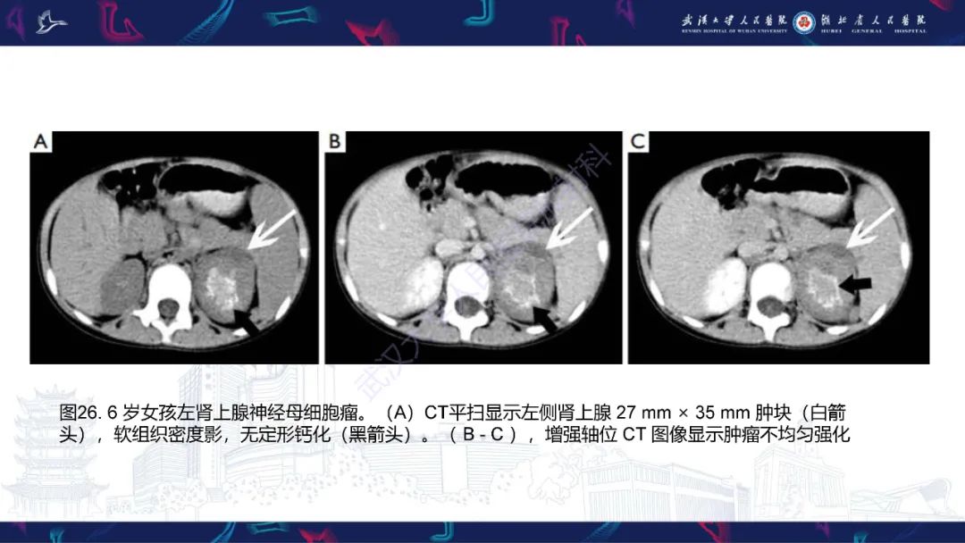 影像PPT - 【PPT】肾上腺常见病变CT及MRI诊断-44