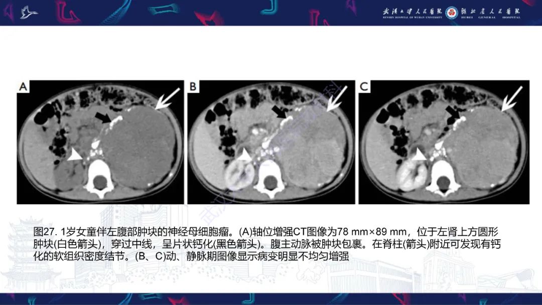 影像PPT - 【PPT】肾上腺常见病变CT及MRI诊断-45