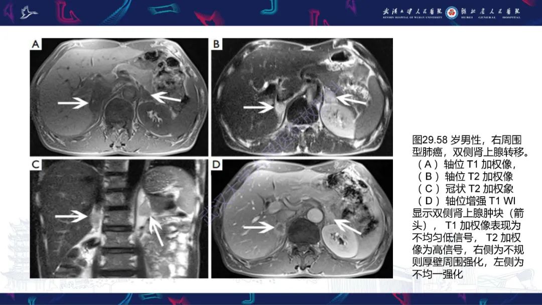 影像PPT - 【PPT】肾上腺常见病变CT及MRI诊断-48