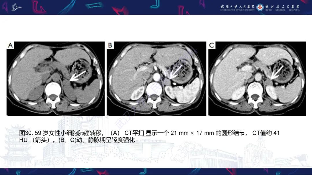 影像PPT - 【PPT】肾上腺常见病变CT及MRI诊断-49