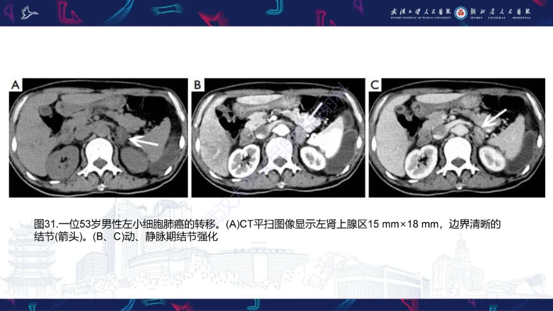 影像PPT - 【PPT】肾上腺常见病变CT及MRI诊断-50
