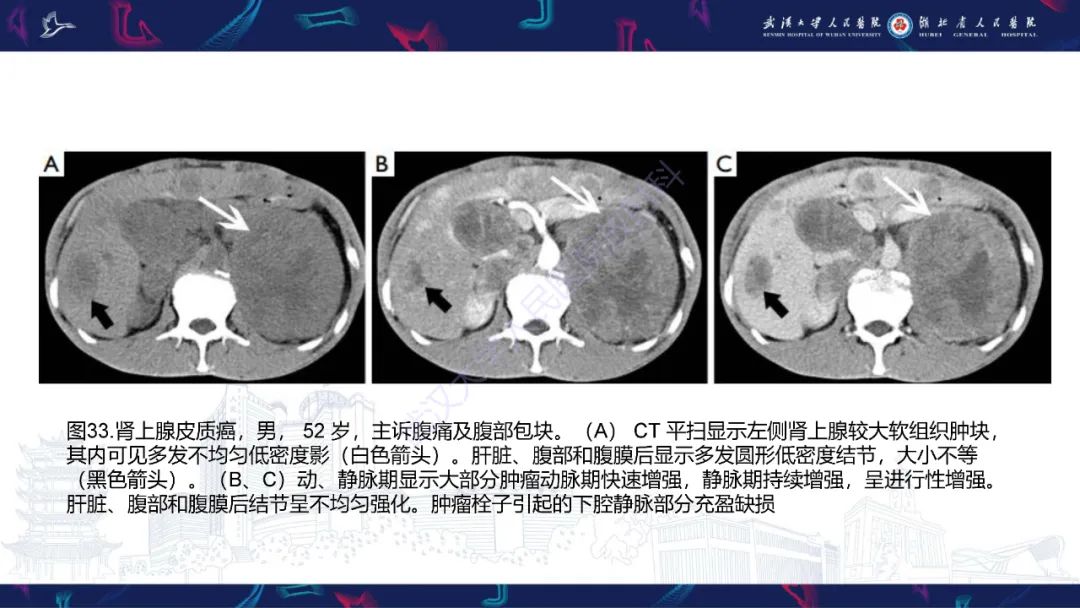 影像PPT - 【PPT】肾上腺常见病变CT及MRI诊断-53