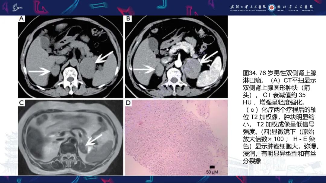 影像PPT - 【PPT】肾上腺常见病变CT及MRI诊断-55