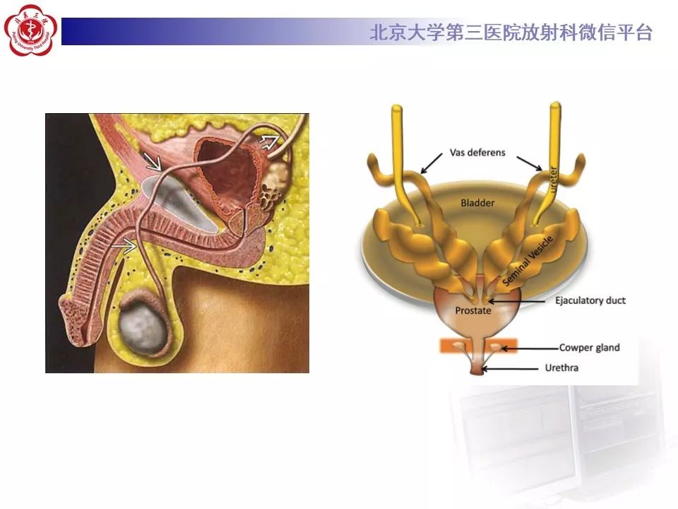 影像PPT - 【PPT】射精管-精囊区梗阻性无精子症-4