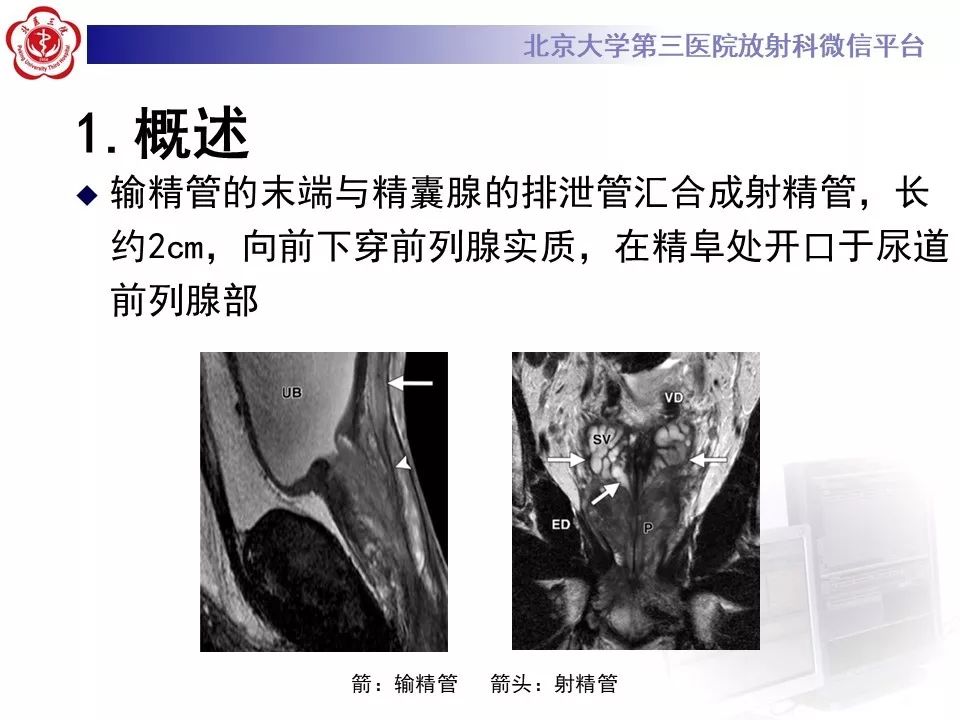 影像PPT - 【PPT】射精管-精囊区梗阻性无精子症-6
