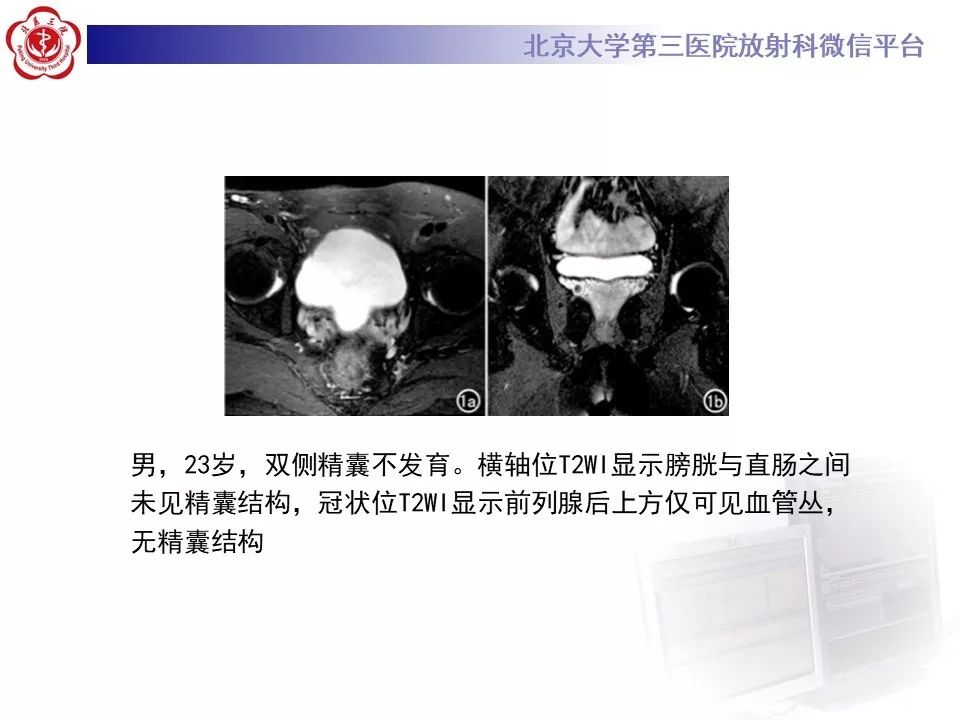 影像PPT - 【PPT】射精管-精囊区梗阻性无精子症-9