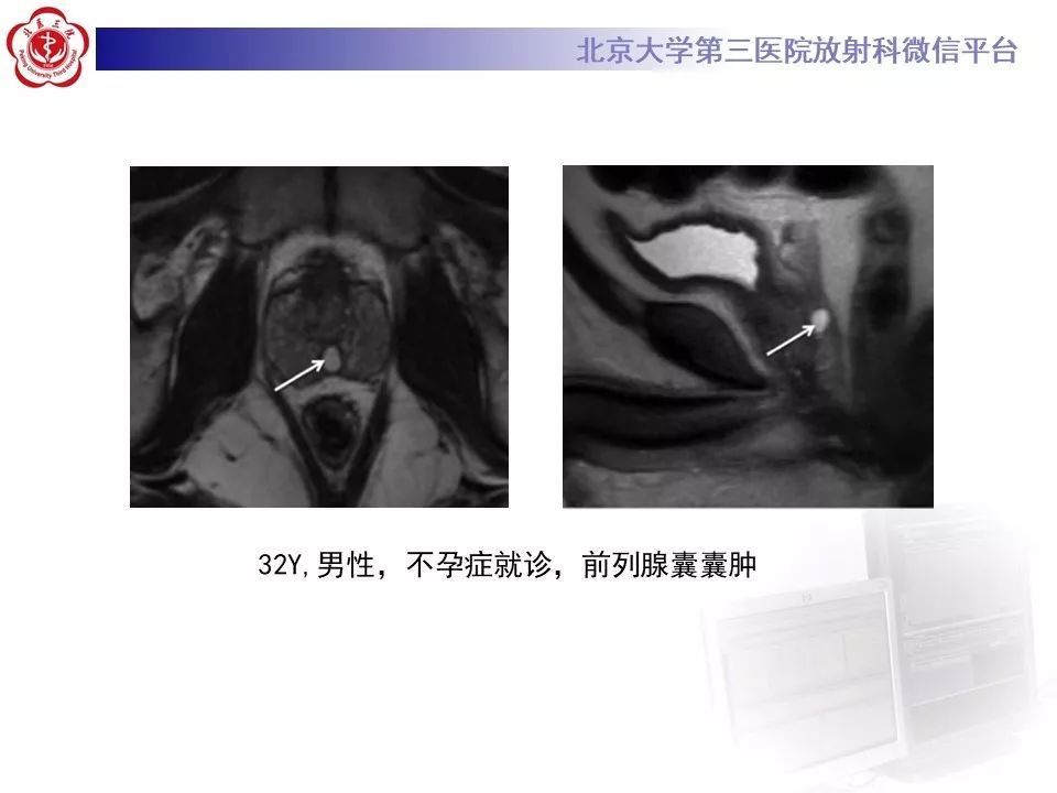 影像PPT - 【PPT】射精管-精囊区梗阻性无精子症-12