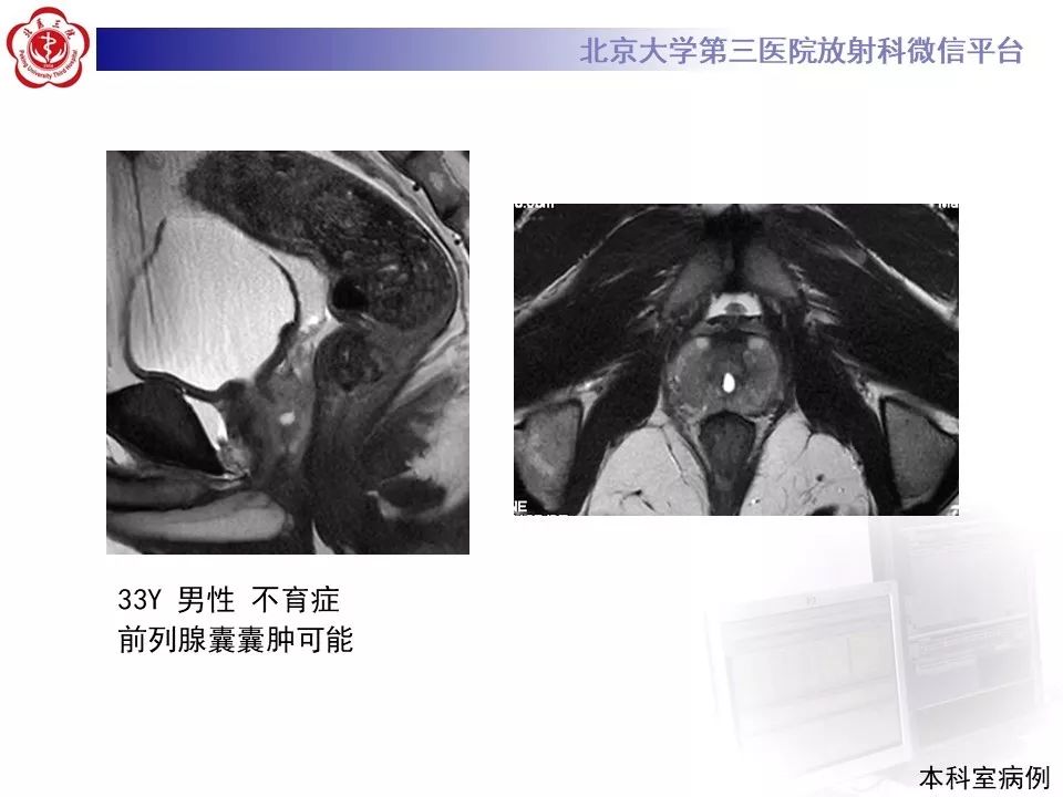 影像PPT - 【PPT】射精管-精囊区梗阻性无精子症-13