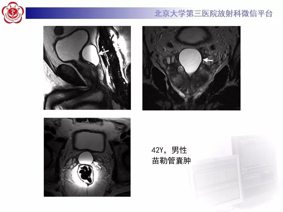 影像PPT - 【PPT】射精管-精囊区梗阻性无精子症-16