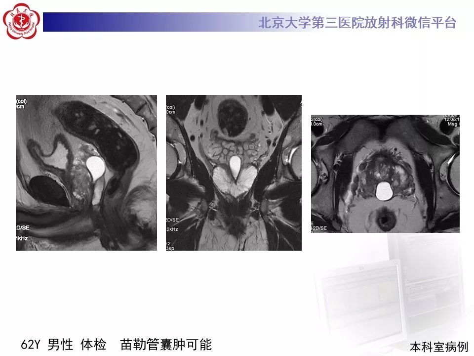 影像PPT - 【PPT】射精管-精囊区梗阻性无精子症-17
