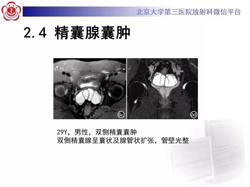 影像PPT - 【PPT】射精管-精囊区梗阻性无精子症-20