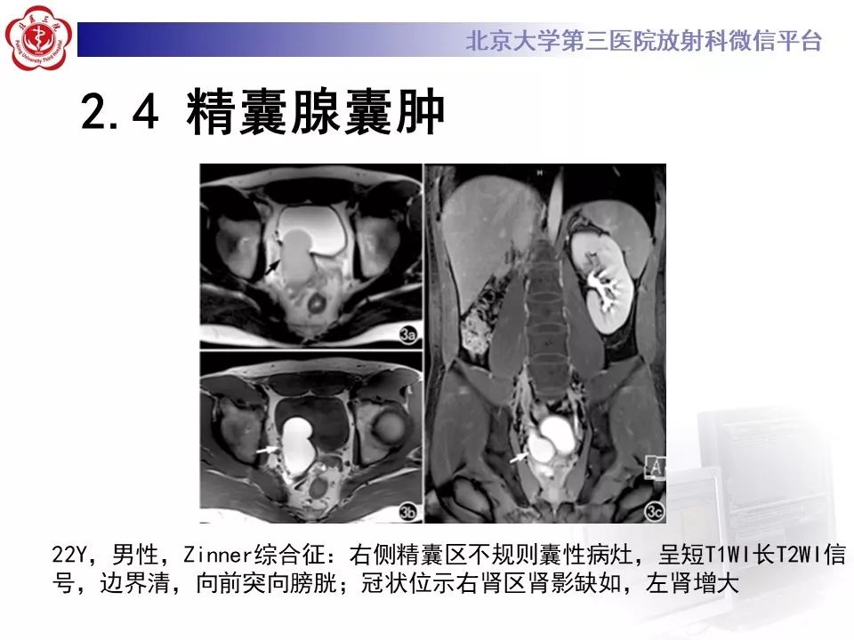 影像PPT - 【PPT】射精管-精囊区梗阻性无精子症-21