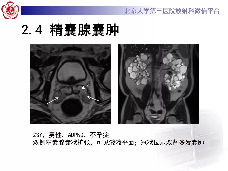 影像PPT - 【PPT】射精管-精囊区梗阻性无精子症-22