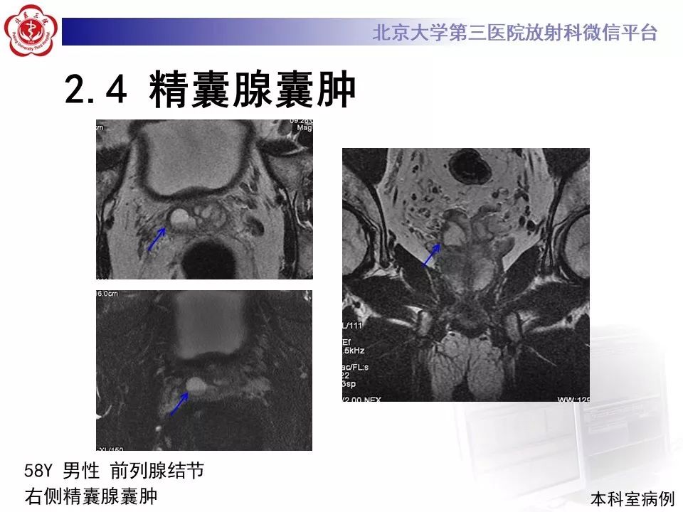 影像PPT - 【PPT】射精管-精囊区梗阻性无精子症-23