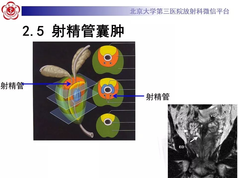 影像PPT - 【PPT】射精管-精囊区梗阻性无精子症-24