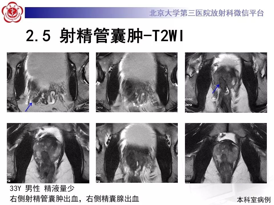 影像PPT - 【PPT】射精管-精囊区梗阻性无精子症-27