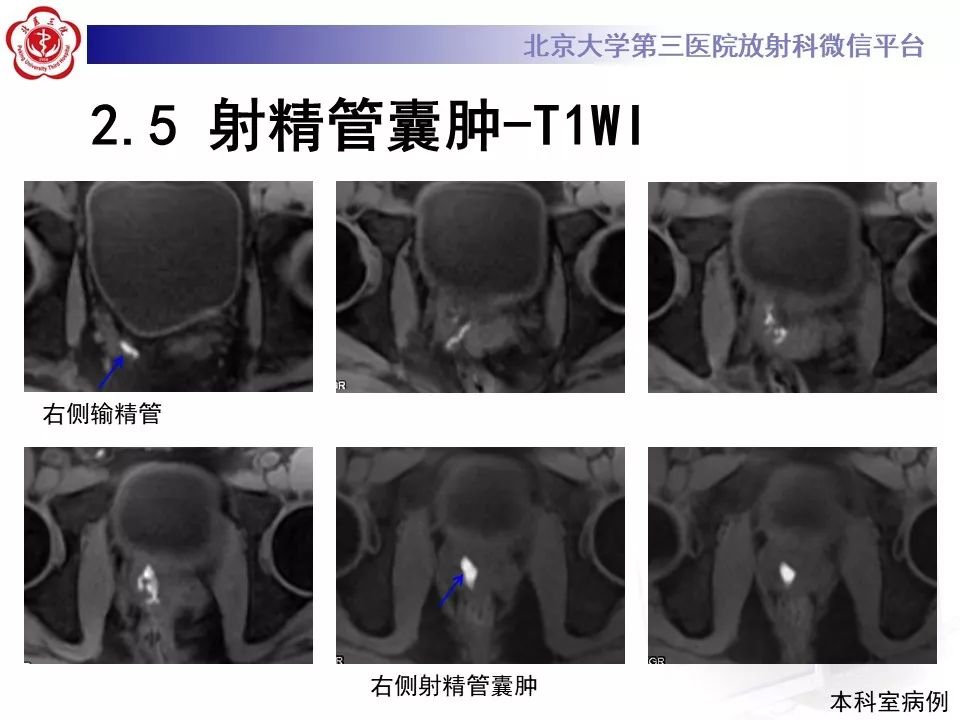 影像PPT - 【PPT】射精管-精囊区梗阻性无精子症-28
