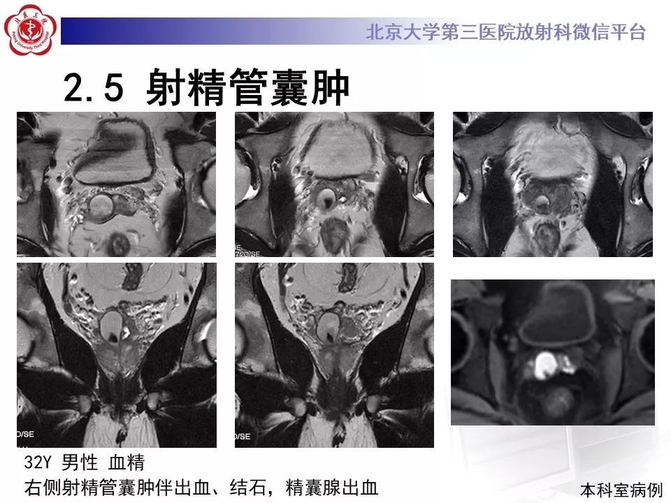 影像PPT - 【PPT】射精管-精囊区梗阻性无精子症-29