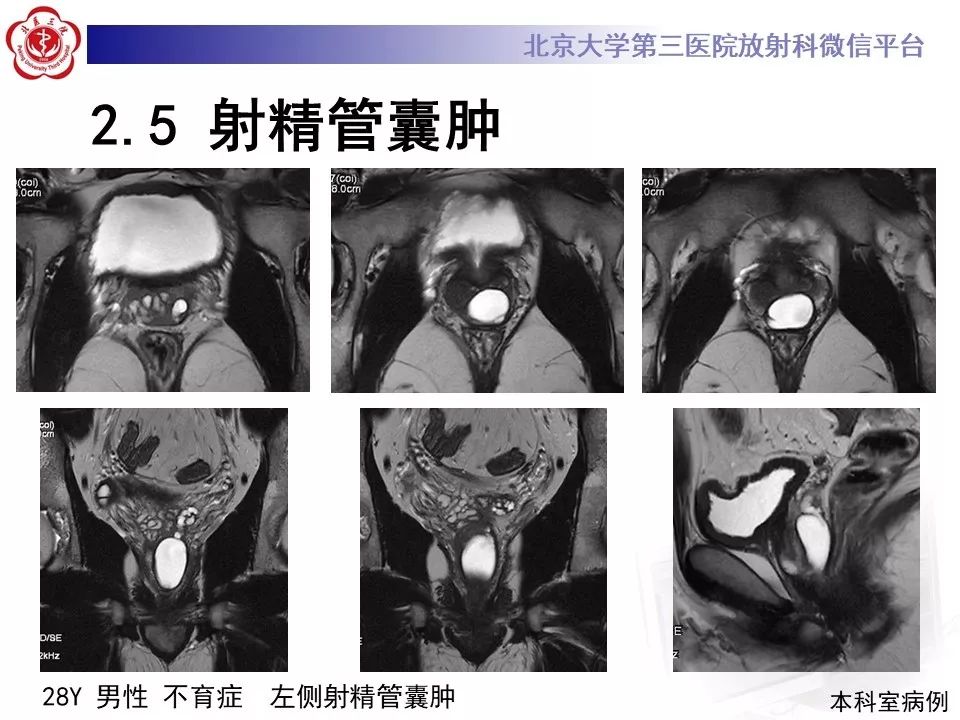 影像PPT - 【PPT】射精管-精囊区梗阻性无精子症-30