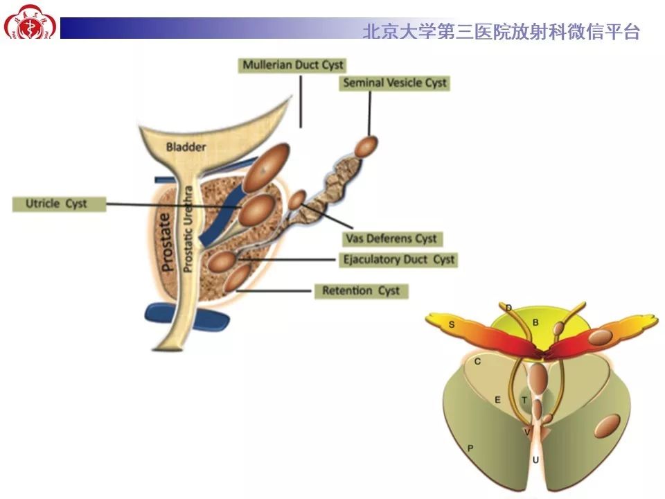 影像PPT - 【PPT】射精管-精囊区梗阻性无精子症-31