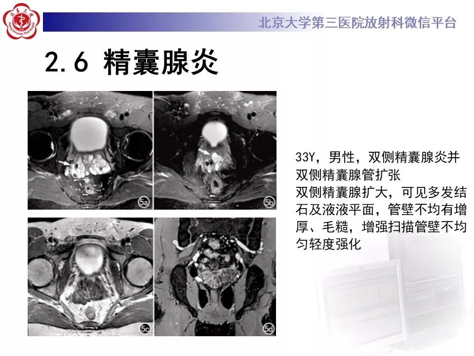 影像PPT - 【PPT】射精管-精囊区梗阻性无精子症-34