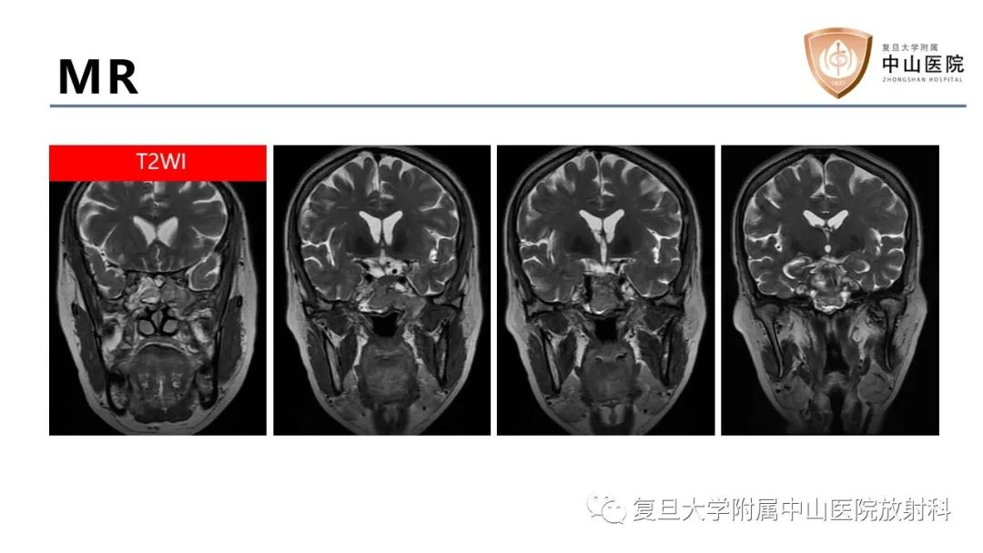 影像PPT - 【病例】蝶窦异位垂体腺瘤1例CT及MR-4