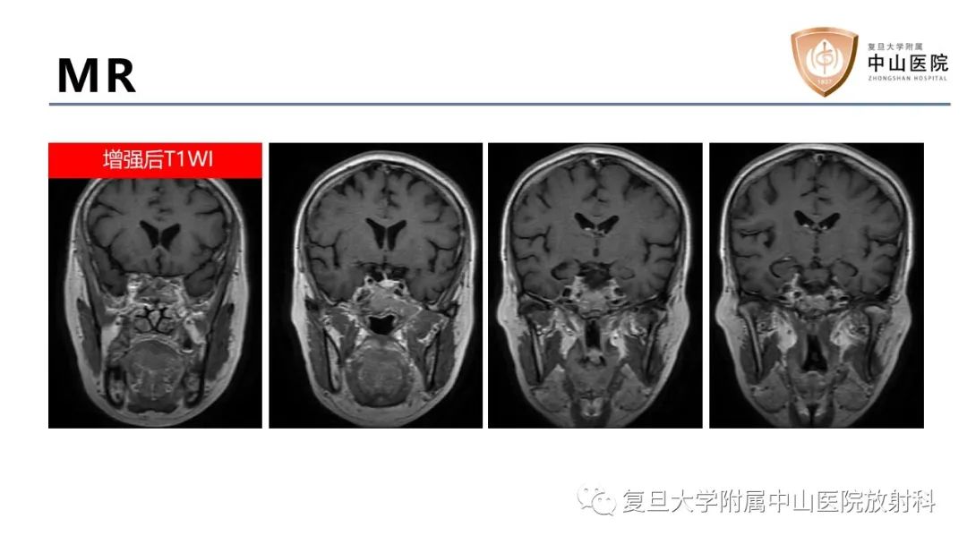 影像PPT - 【病例】蝶窦异位垂体腺瘤1例CT及MR-6