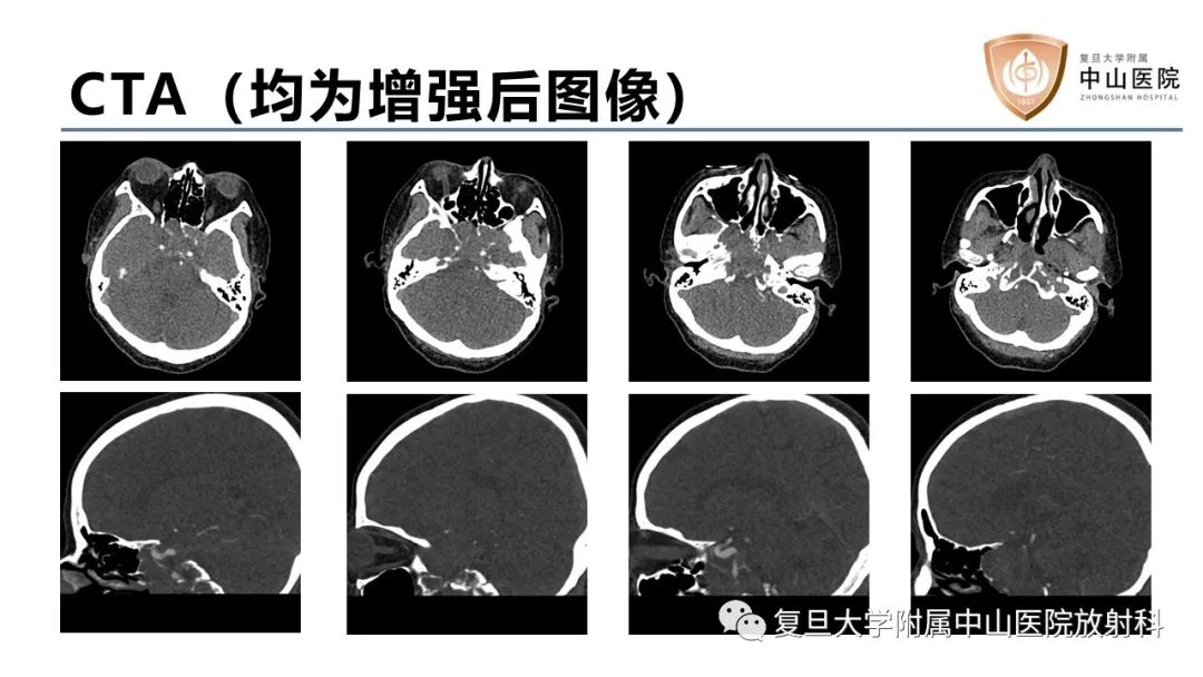 影像PPT - 【病例】蝶窦异位垂体腺瘤1例CT及MR-3
