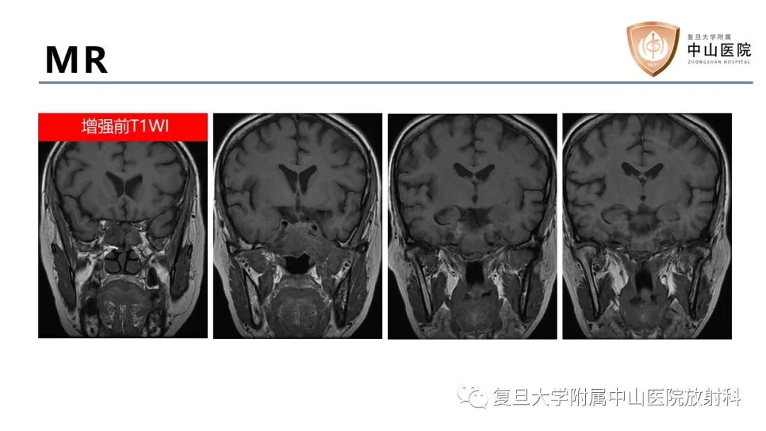 影像PPT - 【病例】蝶窦异位垂体腺瘤1例CT及MR-5