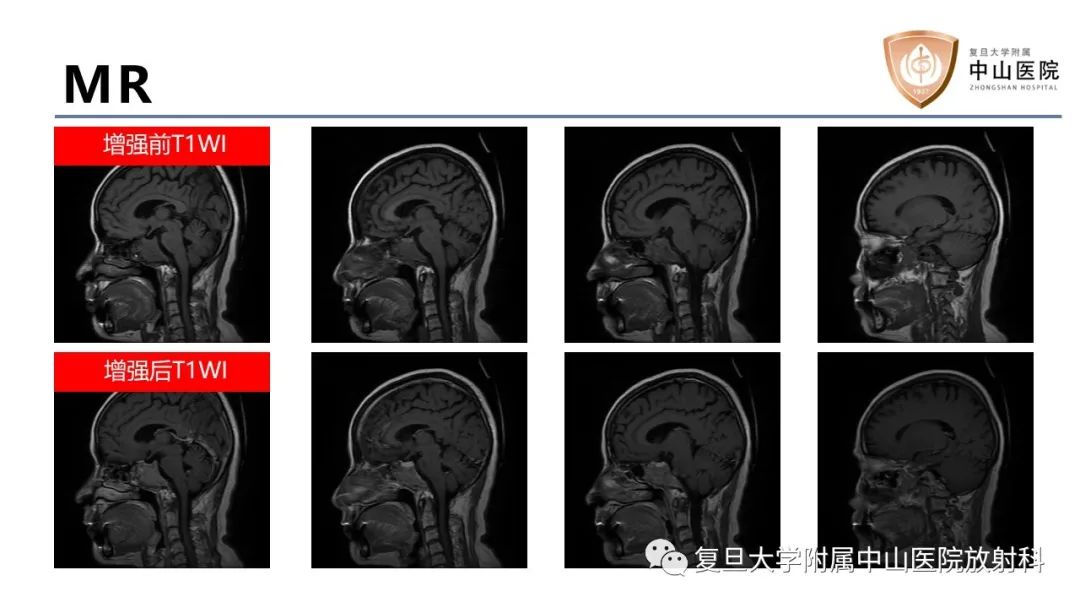 影像PPT - 【病例】蝶窦异位垂体腺瘤1例CT及MR-7