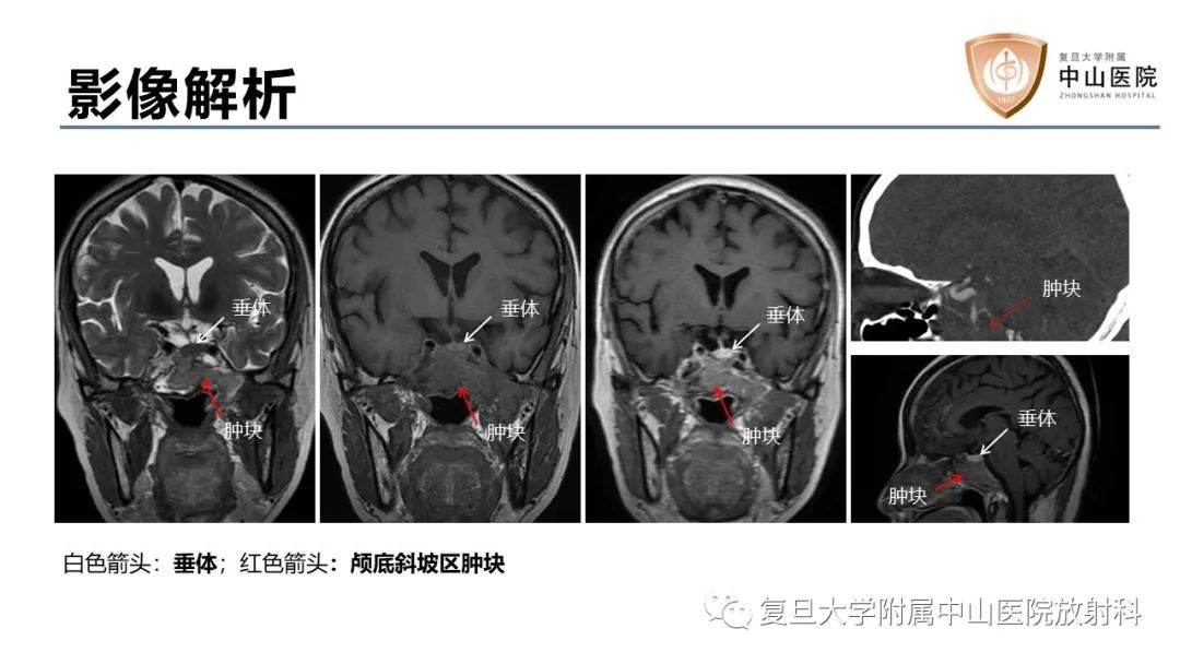 影像PPT - 【病例】蝶窦异位垂体腺瘤1例CT及MR-10