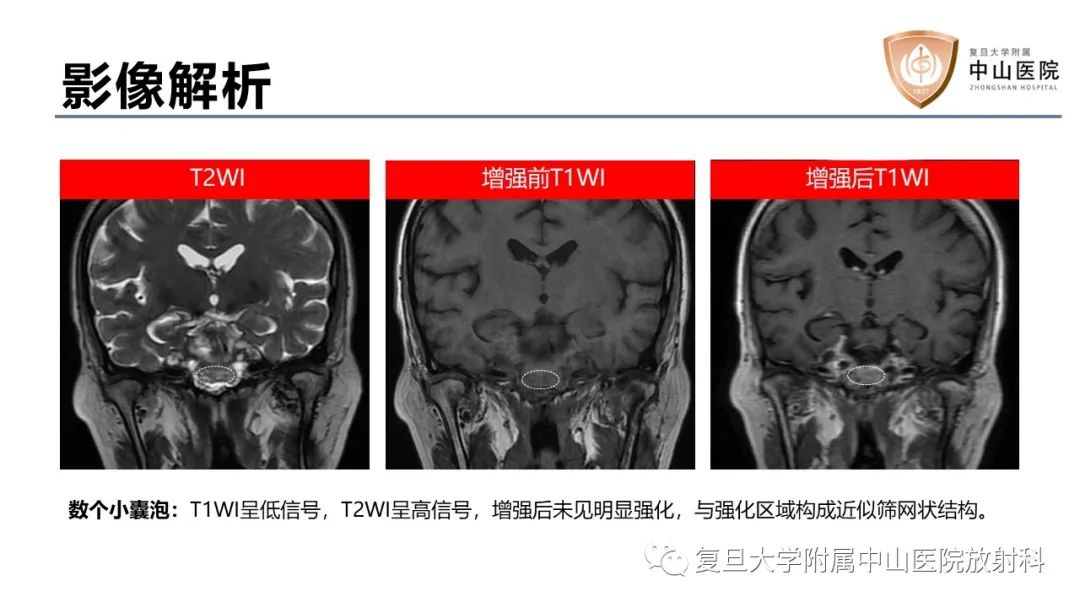 影像PPT - 【病例】蝶窦异位垂体腺瘤1例CT及MR-11