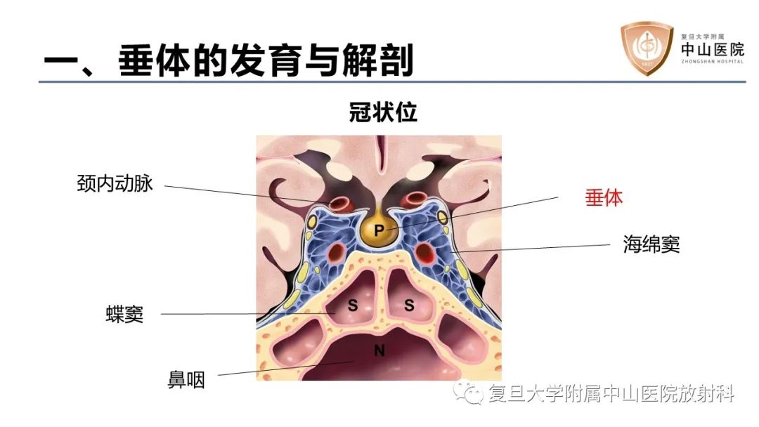 影像PPT - 【病例】蝶窦异位垂体腺瘤1例CT及MR-15