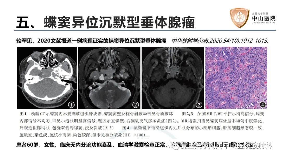 影像PPT - 【病例】蝶窦异位垂体腺瘤1例CT及MR-27
