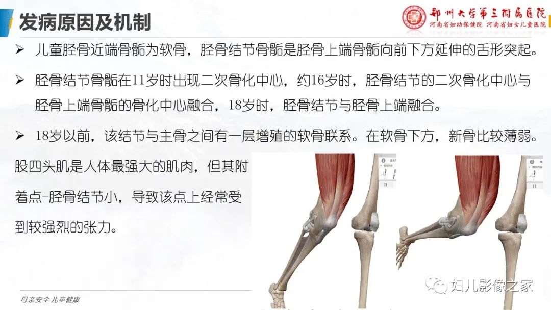 影像PPT - 【PPT】胫骨结节骨软骨炎的影像诊断-6