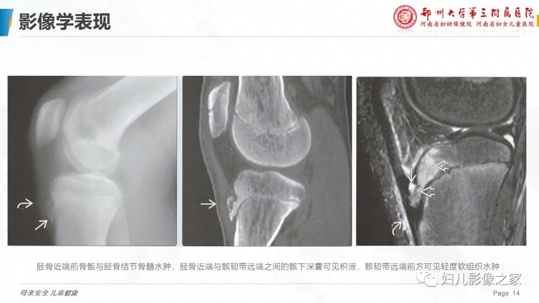 影像PPT - 【PPT】胫骨结节骨软骨炎的影像诊断-14