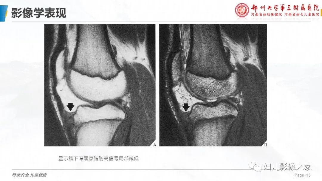 影像PPT - 【PPT】胫骨结节骨软骨炎的影像诊断-13
