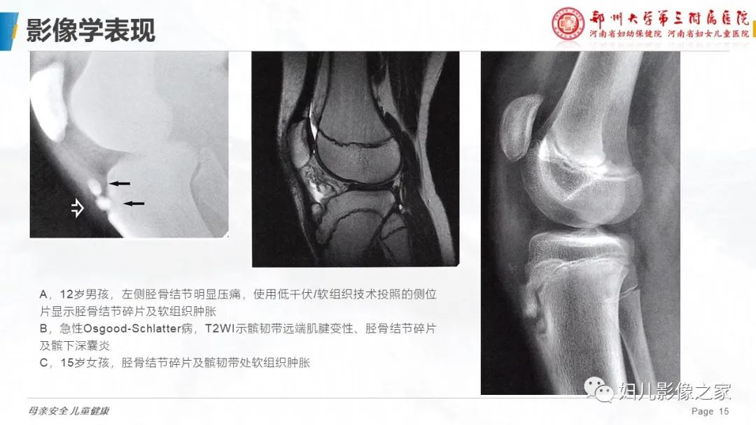 影像PPT - 【PPT】胫骨结节骨软骨炎的影像诊断-15