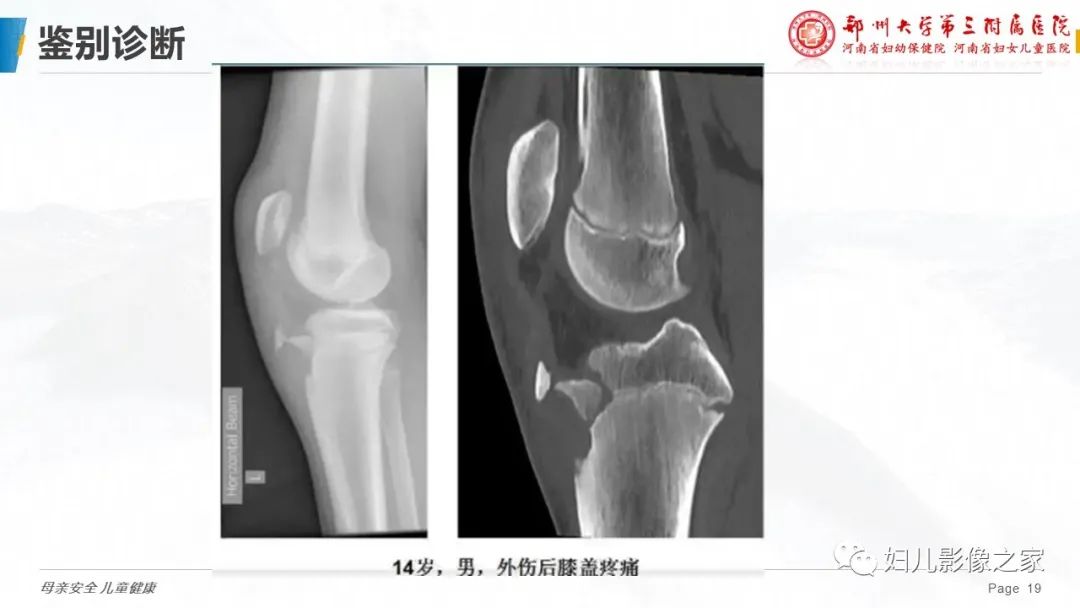 影像PPT - 【PPT】胫骨结节骨软骨炎的影像诊断-19