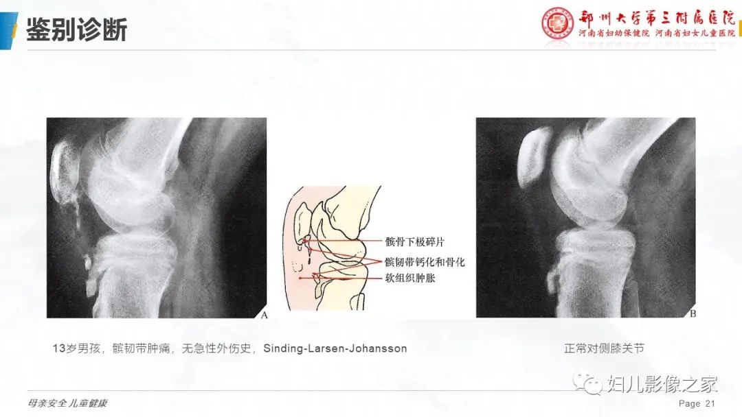 影像PPT - 【PPT】胫骨结节骨软骨炎的影像诊断-21