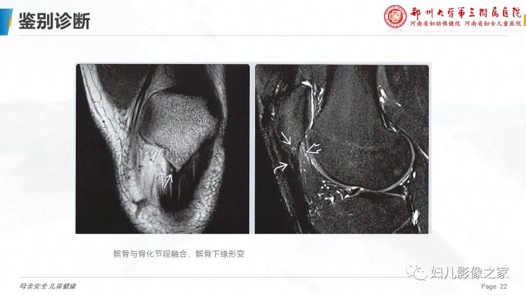 影像PPT - 【PPT】胫骨结节骨软骨炎的影像诊断-22